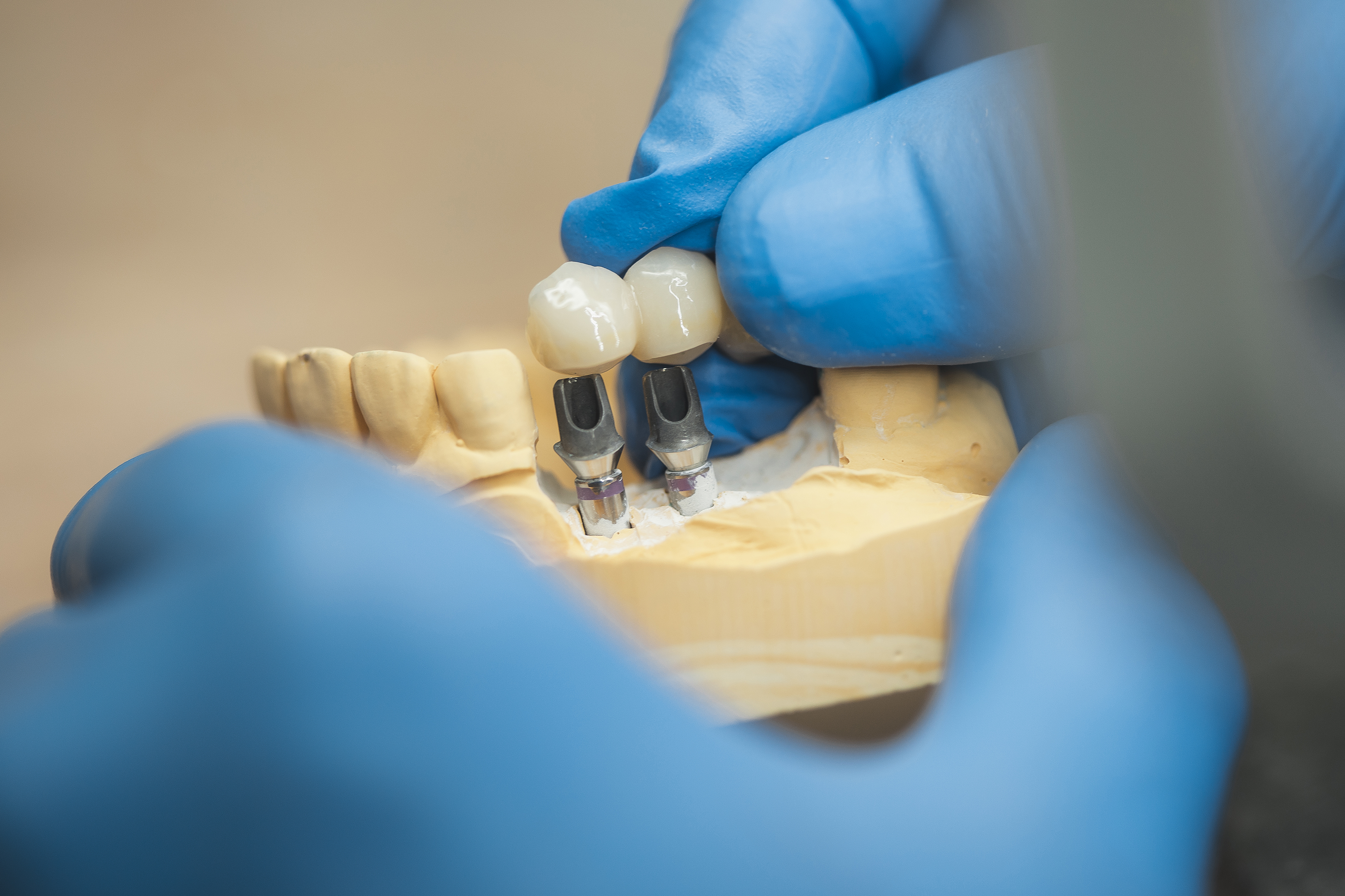 CEREC - Zahnersatz